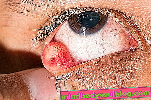 Chalazion dans l'œil: qu'est-ce que c'est, principaux symptômes et traitement
