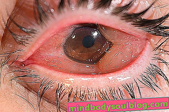 Qu'est-ce que la chimiose oculaire et comment le traitement est-il effectué