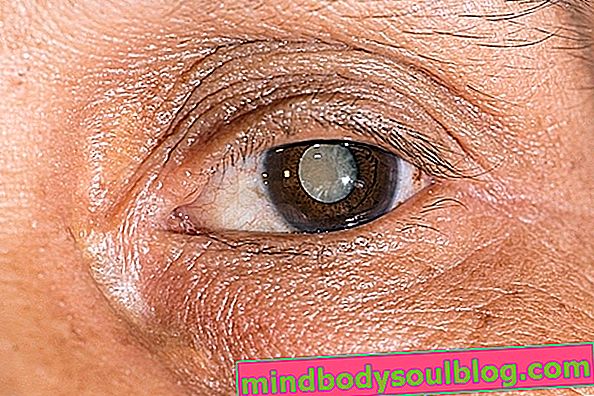 Tache oculaire caractéristique de la cataracte