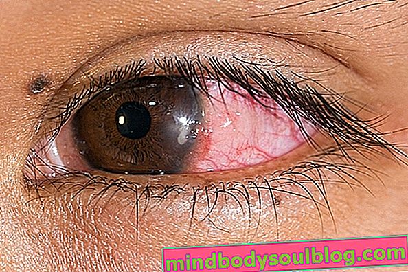 角膜炎：それが何であるか、主な種類、症状および治療