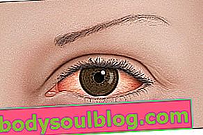 Rosacée oculaire: qu'est-ce que c'est, symptômes et traitement