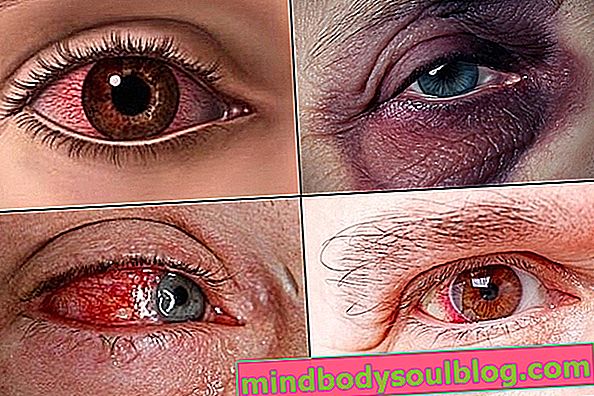 Какво да направите в случай на нараняване на очите