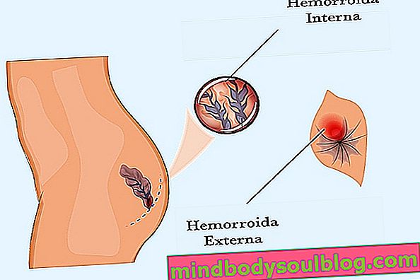Domowe środki na hemoroidy