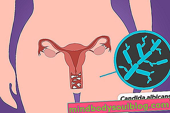 Kandidiasis vagina: apa itu, gejala dan pilihan pengobatan