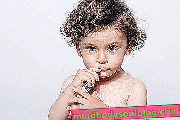 Roseola infantil: gejala, penularan dan cara pengobatan