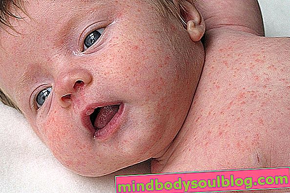 Baby-Hautallergie: Hauptursachen, Symptome und was zu tun ist