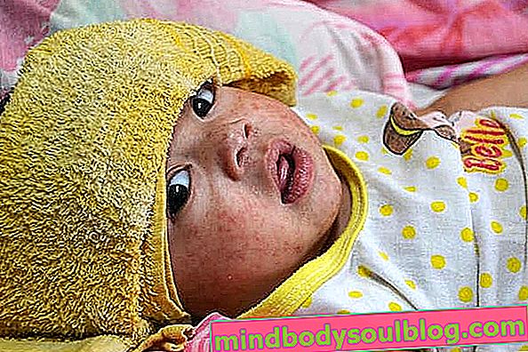 Symptômes et traitement de la rougeole chez les bébés