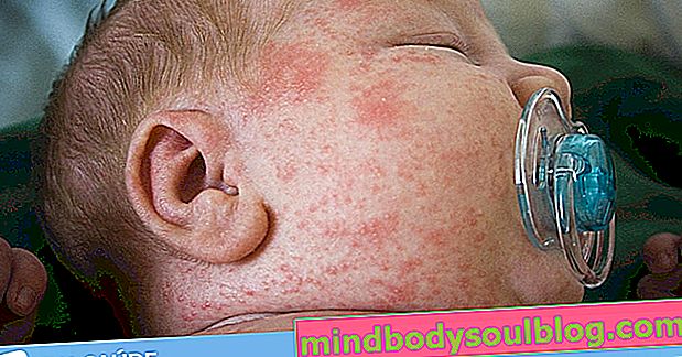 Wie Sie feststellen können, ob Ihr Baby allergisch gegen Kuhmilchprotein ist und wie Sie es behandeln