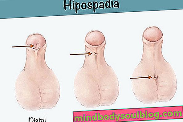 Hipospadia: Apa itu, Jenis dan Perawatan