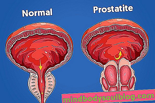 Qu'est-ce que la prostatite, les symptômes et le traitement