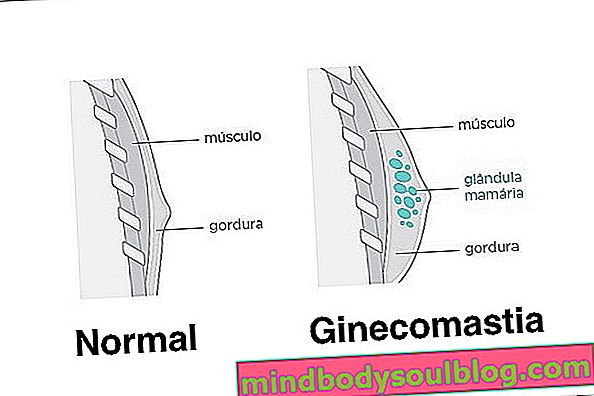 Gynecomastia คืออะไรสาเหตุและวิธีระบุ