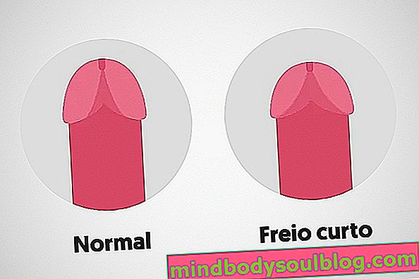 Bagaimana cara mengetahui apakah rem penis Anda pendek dan kapan harus menjalani operasi