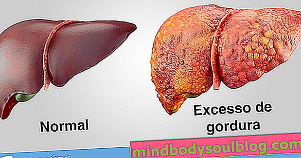 8つの主要な肝臓脂肪症状