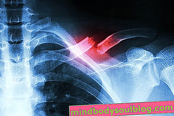 鎖骨骨折のX線写真