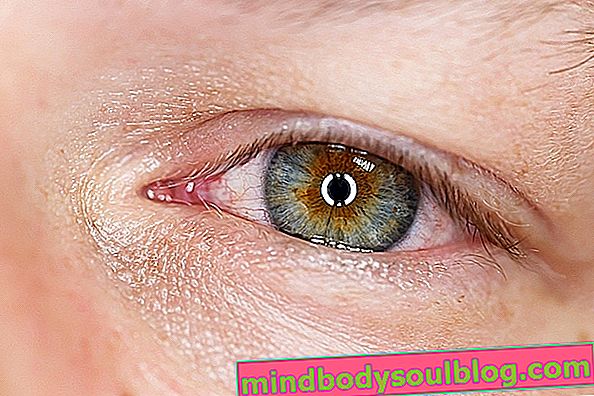 6 principales causes de démangeaisons oculaires et que faire