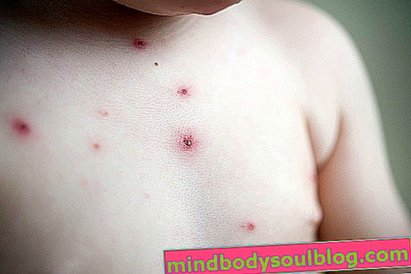 水痘：症状、原因、治療を特定する方法