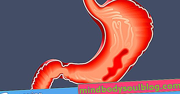 6 principaux symptômes de la gastrite