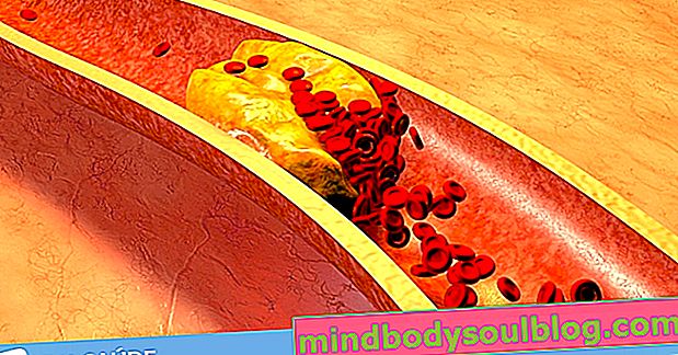 3 Anzeichen, die auf einen hohen Cholesterinspiegel hinweisen können