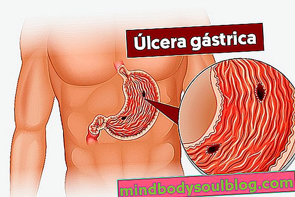 胃潰瘍の6つの症状、主な原因と治療