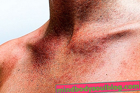 ما هو الطفح الجلدي (الطفح الجلدي) ، الأسباب الرئيسية والعلاج