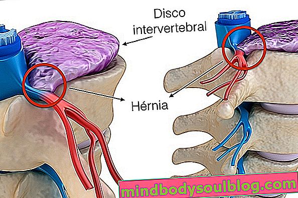 Symptômes de la hernie discale lombaire, cervicale et thoracique et comment prévenir