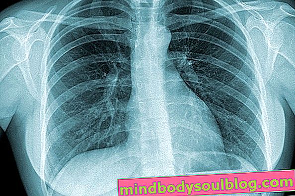 Туберкулез: 7 симптомов, которые могут указывать на инфекцию