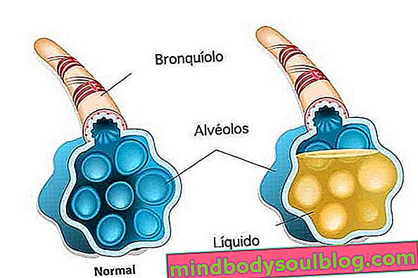 Alveolen mit Lungenentzündung