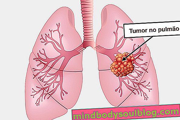 Główne objawy, które mogą wskazywać na raka płuc