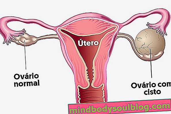 卵巣嚢胞とは何か、主な症状と種類