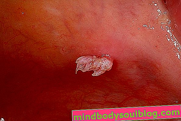 HPV dans le toit de la bouche