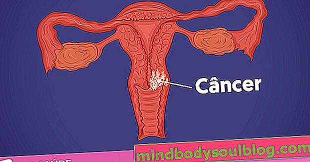 6 Anzeichen, die auf Gebärmutterhalskrebs hinweisen können
