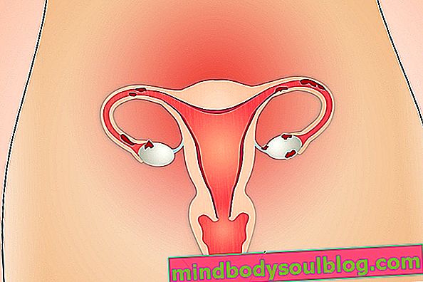 子宮内の炎症の治療：自然療法とオプション