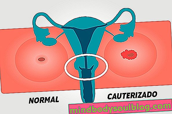 Cautérisation du col de l'utérus: qu'est-ce que c'est, comment cela se fait et récupération