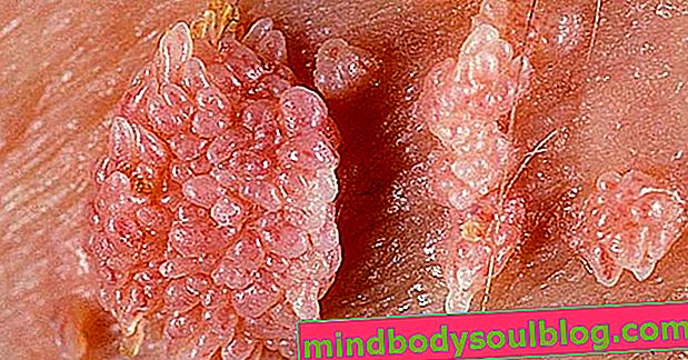 תסמיני HPV בקרב גברים ונשים