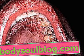 HPV в покрива на устата