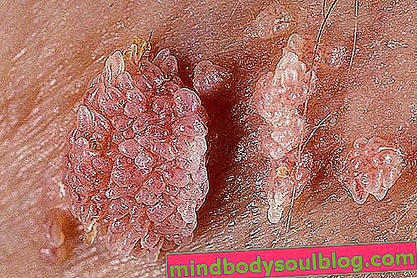 Гребенеста брадавица - HPV