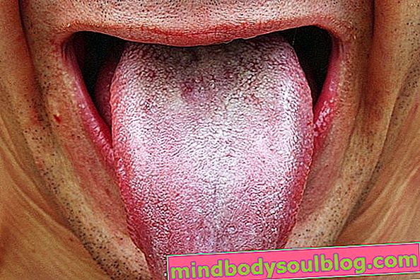 Симптоми на кандидоза на гениталиите, гърлото, кожата и червата