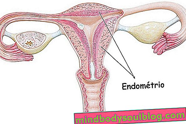 Endometriumverdickung: Was es ist, Ursachen und Behandlung