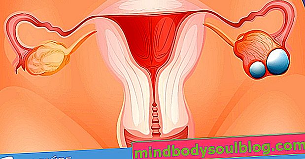 Comment savoir s'il s'agit d'un cancer de l'ovaire