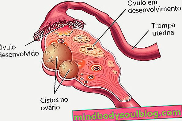 Comment identifier et traiter les ovaires polykystiques