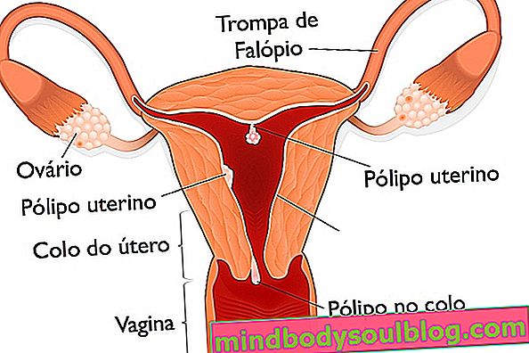 Apa itu Polip pada rahim dan penyebab utama
