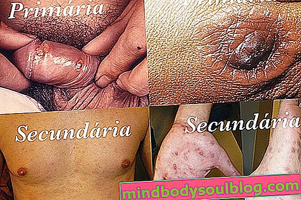 Was ist Syphilis und Hauptsymptome